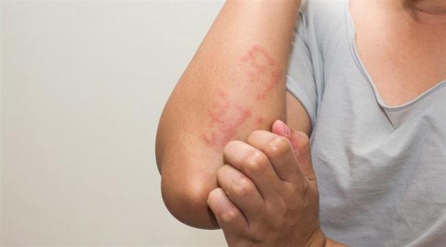 تشققات الجلد سبب محتمل لحساسية الطعام.. علماء يكشفون