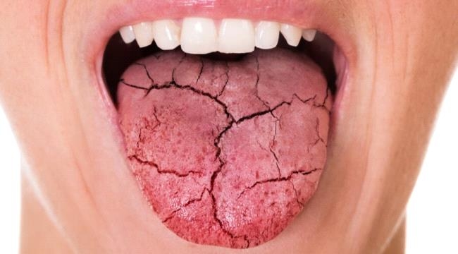 أمل جديد لمرضى جفاف الفم.. علاج صيني يعيد إفراز اللعاب