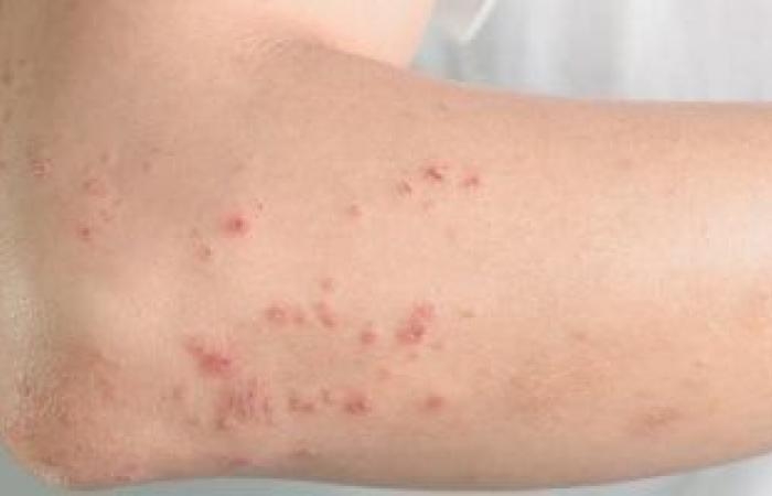 صحة وطب : دراسة: لقاحات الحزام النارى تساهم فى خفض الإصابة بالخرف بنسبة 20%