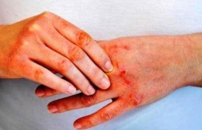 صحة وطب : دراسة: دهون البطن ترتبط بشكل وثيق بالإصابة بالصدفية