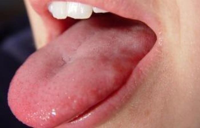 صحة وطب : لماذا يتورم اللسان أحيانا؟ اعرف الأسباب وطرق العلاج