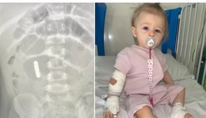 طفلة تفقد جزءاً من أمعائها بسبب مغناطيس لعبة