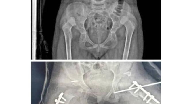 عملية نوعية.. تصحيح عيب خلقي لطفلة في مستشفى الشحر العام