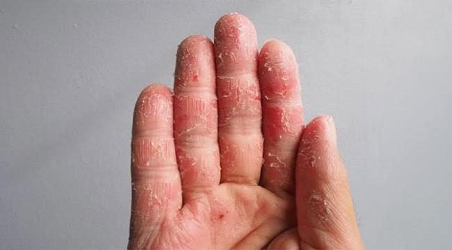 لماذا تتقشر أطراف أصابعك؟ تعرّف على الأسباب الطبية الشائعة