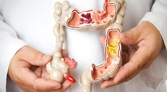 8 أطعمة تقلل خطر الإصابة بسرطان القولون