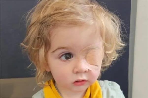 بعد تقبيله فقد عينه.. قصة مؤلمة لطفل تعرض لفيروس الهربس