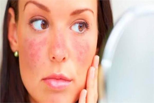 هيئة الدواء تقدم نصائح لمرضى الذئبة الحمراء