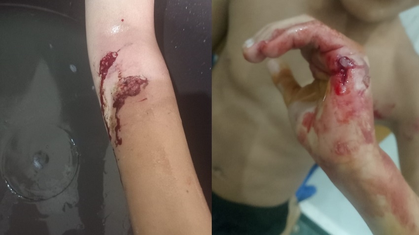 تارودانت: طفل ينجو بأعجوبة من بين أنياب كلب ضال