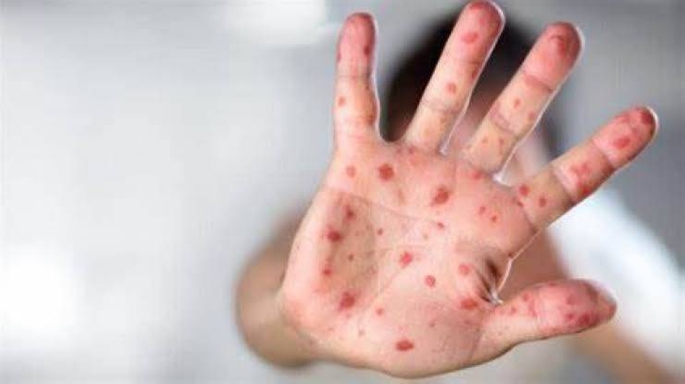 أزمة صحية في تكساس.. تنتشر في دالاس وتثير الذعر بين السكان
