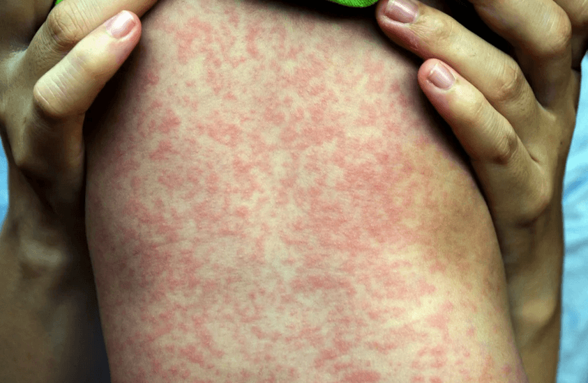 إنذار صحي في أمريكا: إصابات الحصبة تتجاوز الألف حالة في أعلى حصيلة منذ سنوات