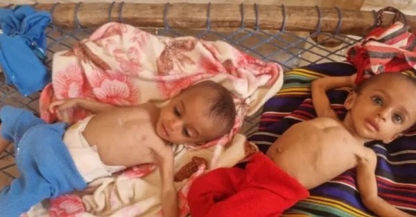 وفاة طفلة نازحة جراء سوء التغذية.. المجاعة تطرق أبواب اليمن