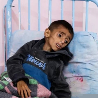 «الصحة العالمية»: أطفال غزة يتعرضون للتجويع والتدمير الجسدي ونحن متواطئون