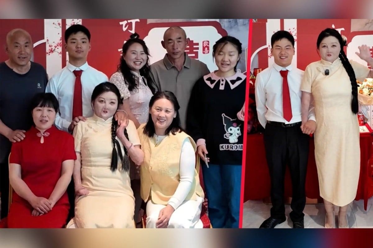 ‘Wonderful fate': China woman with 95% burns reveals she and fiance share same birthday