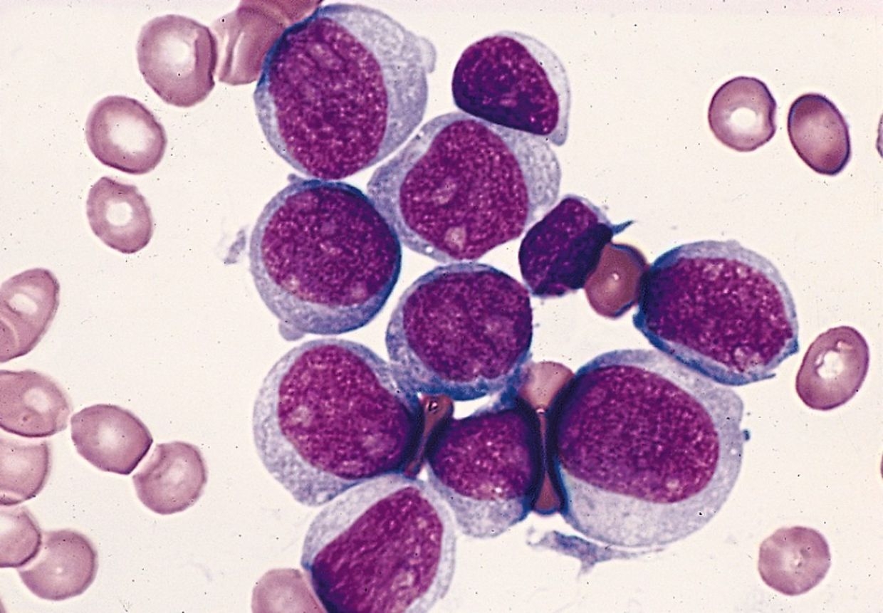 Acute myeloid leukaemia: New test improves survival time