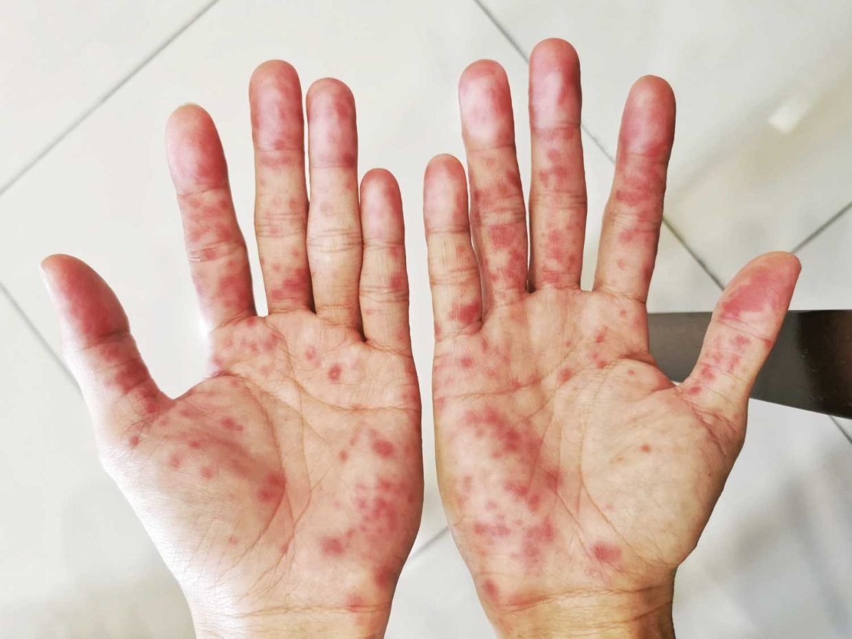 Parents on alert for HFMD