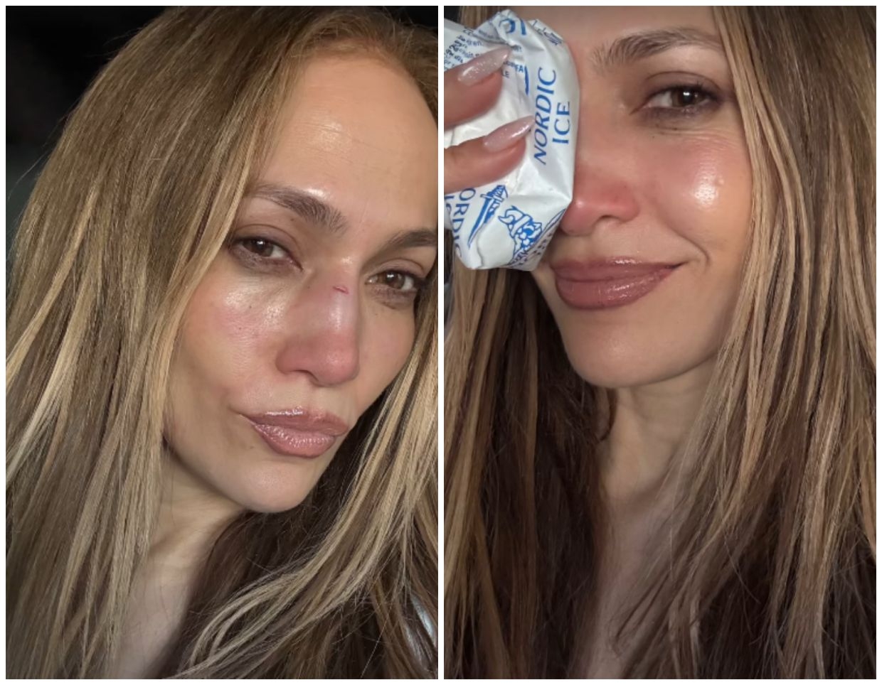 Jennifer Lopez needed facial stitches due to AMAs rehearsal injuries