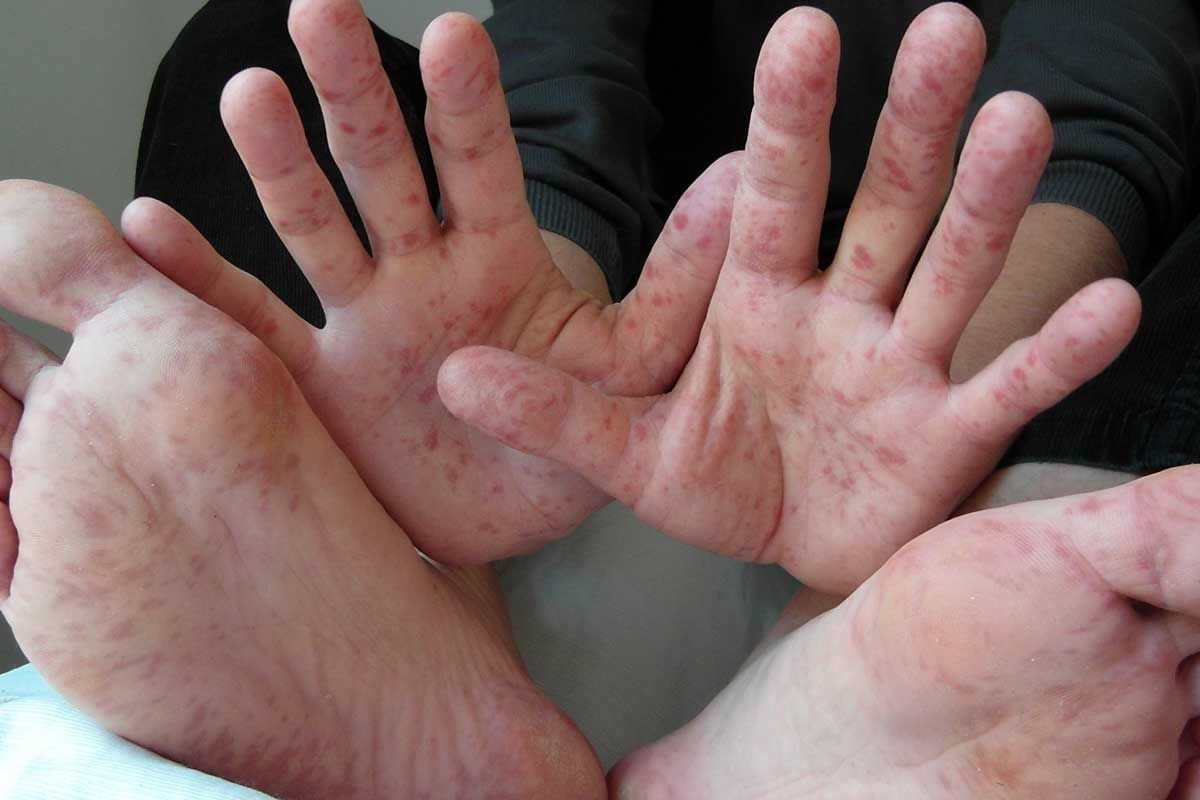 Childcare centres and kindies urged to do HFMD screenings
