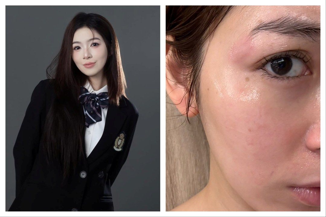 Actress Daphne Low suffers first-degree burn from curling iron in stylist mishap
