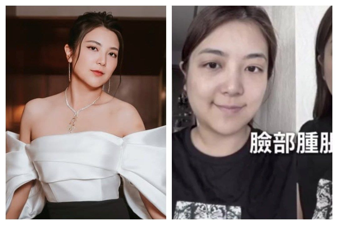 Phoebe Sin shares photos of swollen face, reveals she was sick for over a month