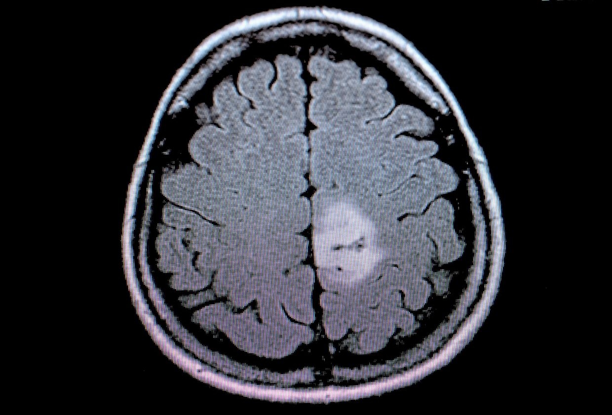 New brain cancer test speeds up results to just hours from weeks