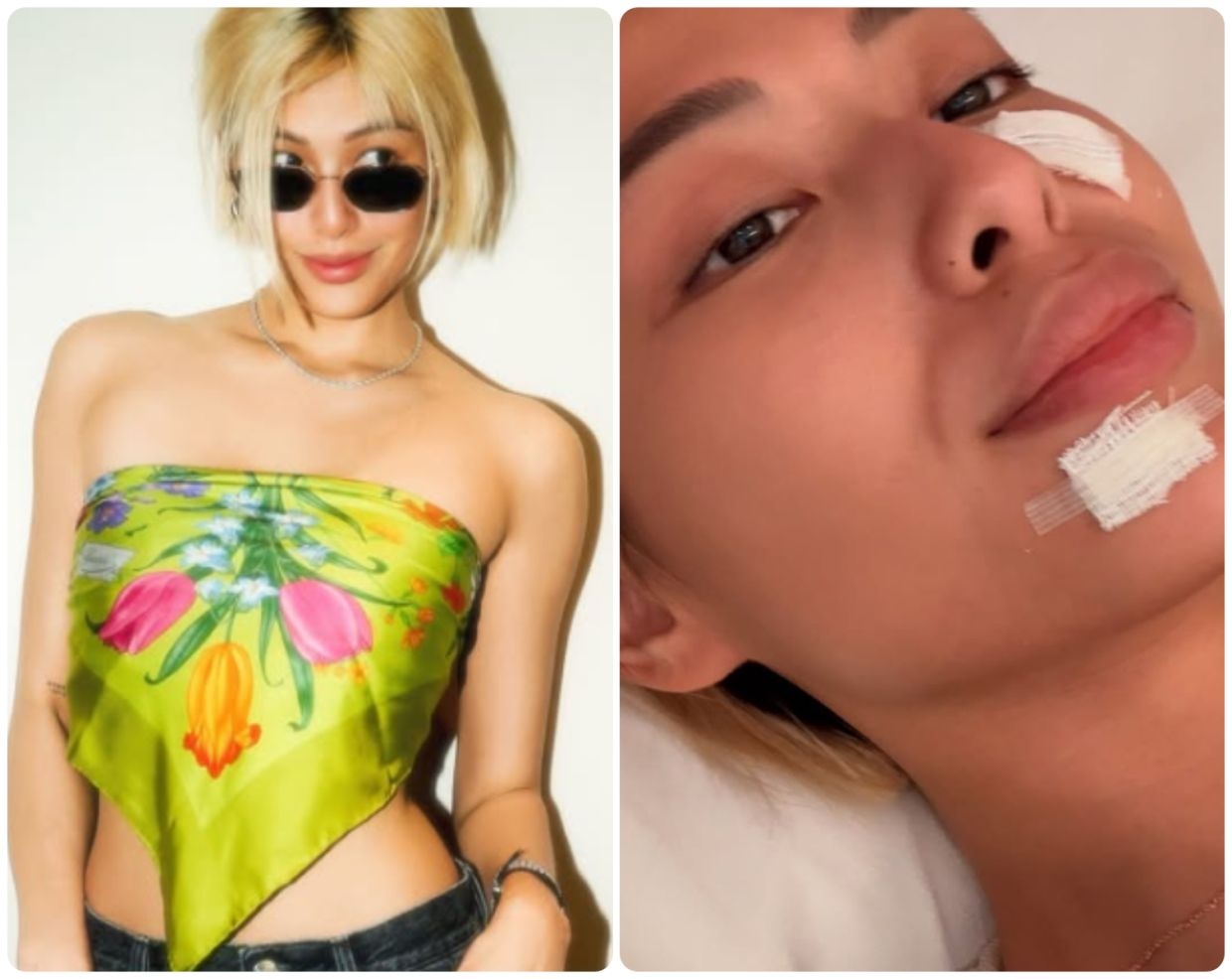 Filipino actress Michelle Dee bitten in the face by pet dog