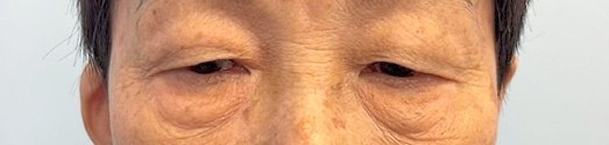 These are not sleepy eyes, but a weakness of the eyelids