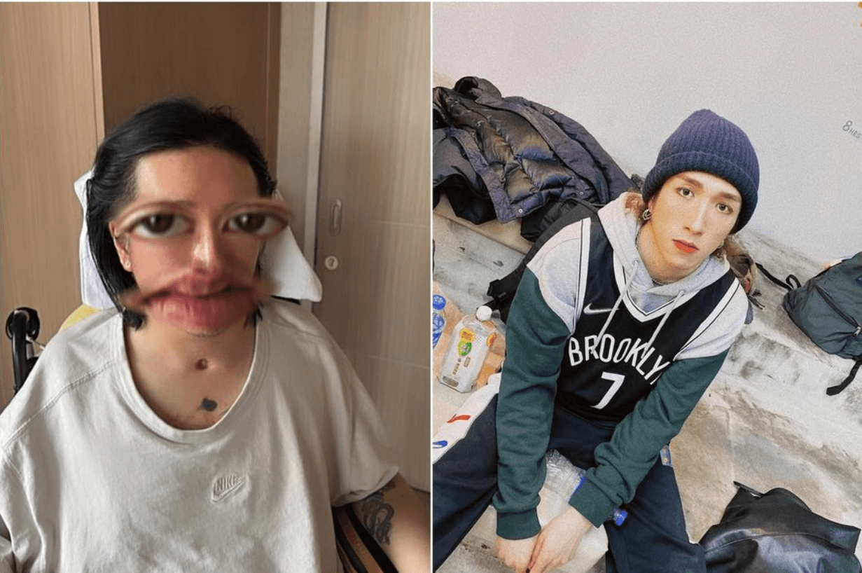Dancer Lee Kai Yin shares first photo of face since Mirror accident in 2022