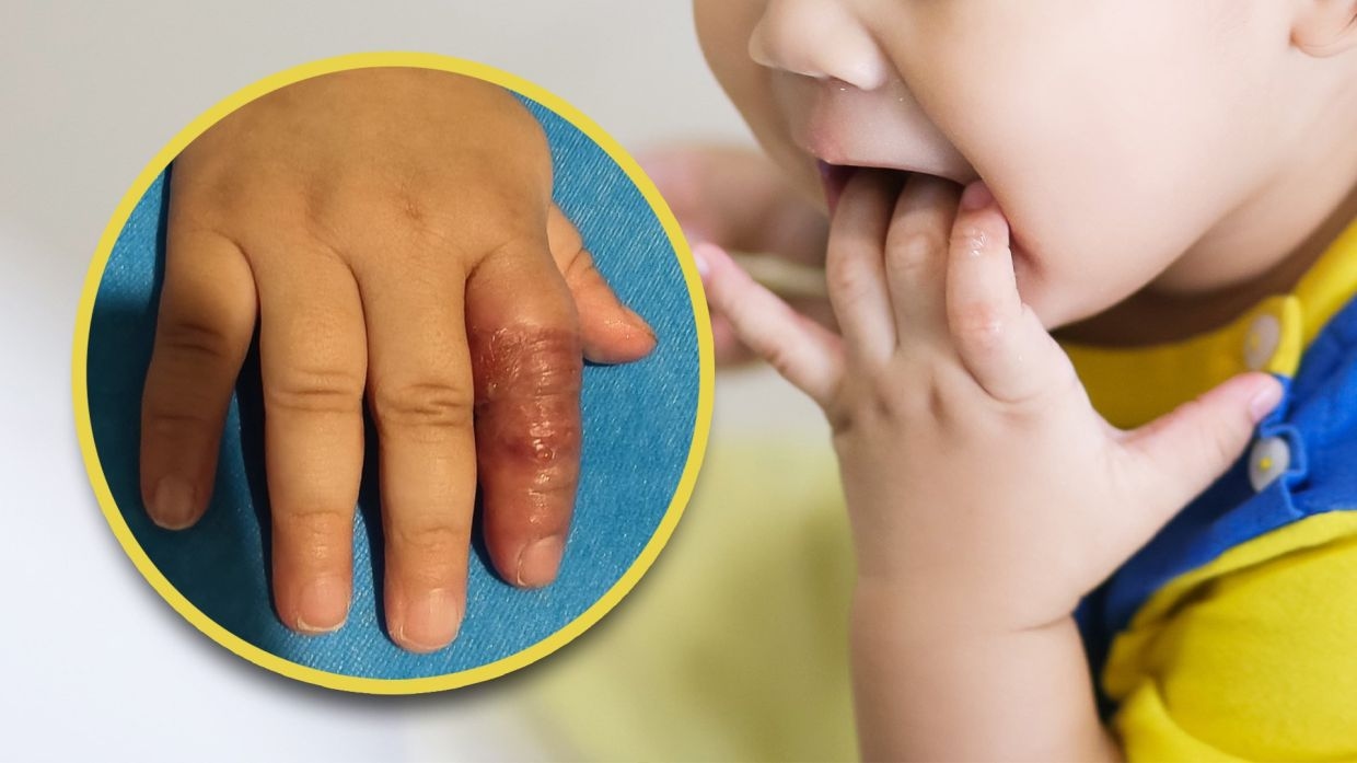 China mum wraps baby's finger to stop ‘unhygienic' sucking, leads to tissue damage
