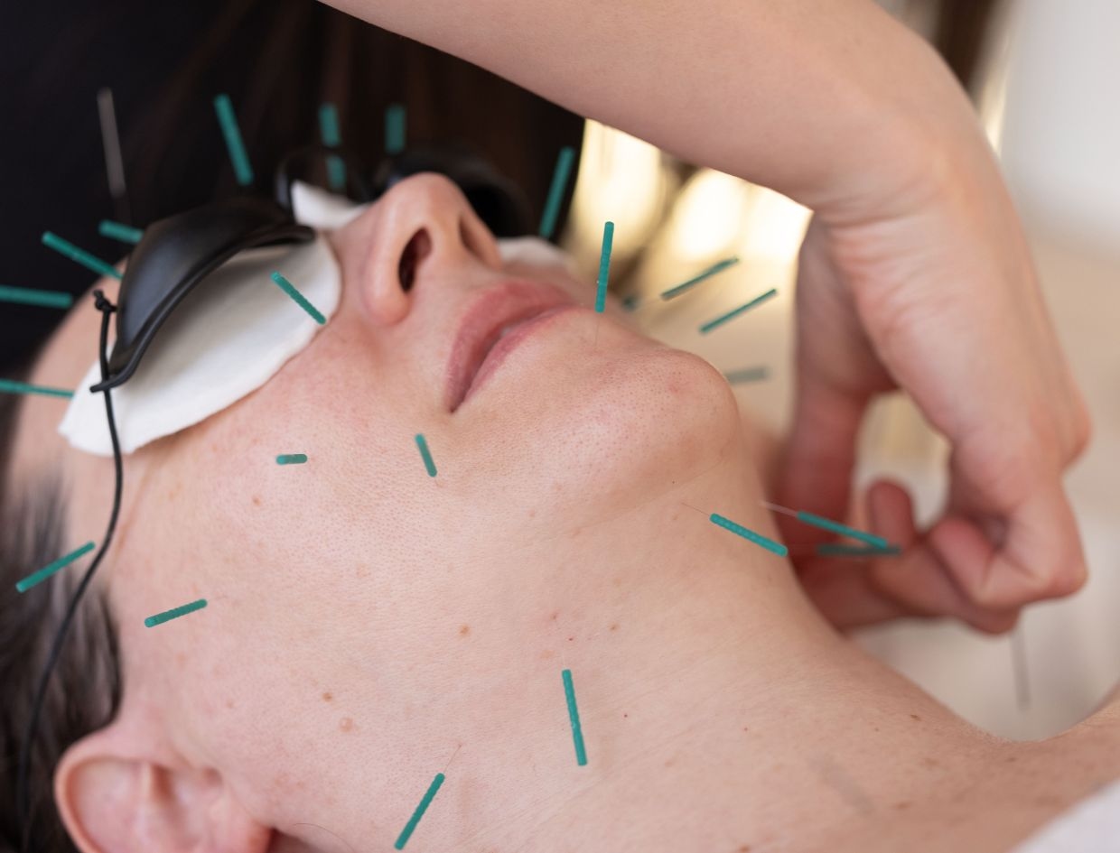 What are acupuncture facials and do they really work for glowing skin?