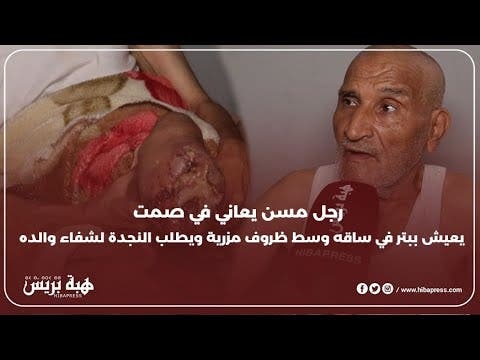 "رجل مسن يعاني في صمت: يعيش ببتر في ساقه وسط ظروف مزرية ويطلب النجدة لشفاء والده"