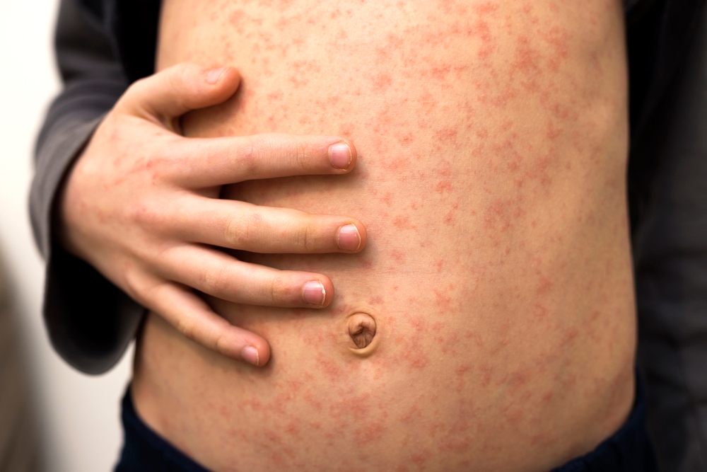 Measles spread in Amsterdam prompts travel advisory for families going to Morocco