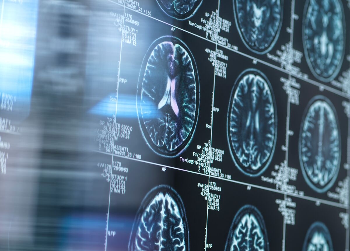 Roche to Test Whether New Drug Can Prevent Alzheimer's Disease