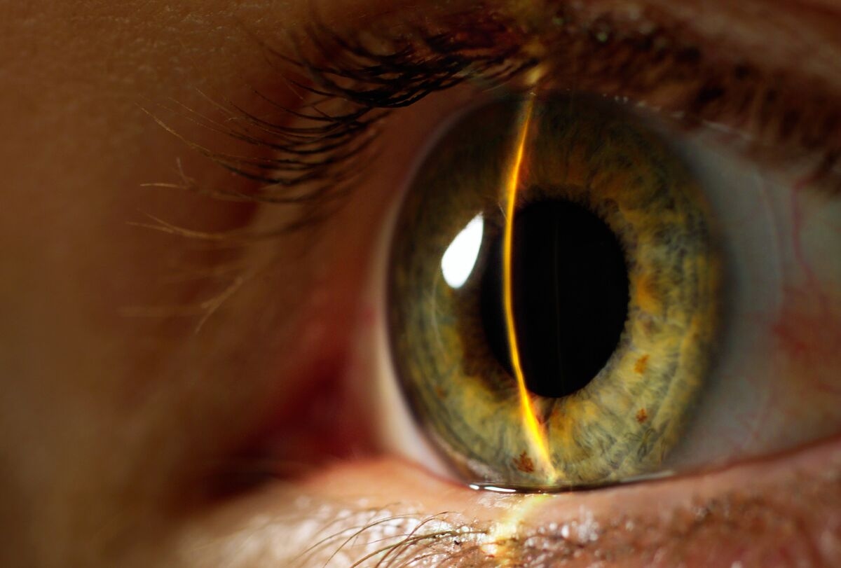 Alcon to Buy Staar for $1.5 Billion in Vision Surgery Expansion