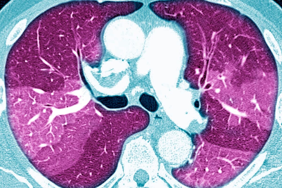 Boehringer Banks on New Lung Fibrosis Drug Being a Game Changer