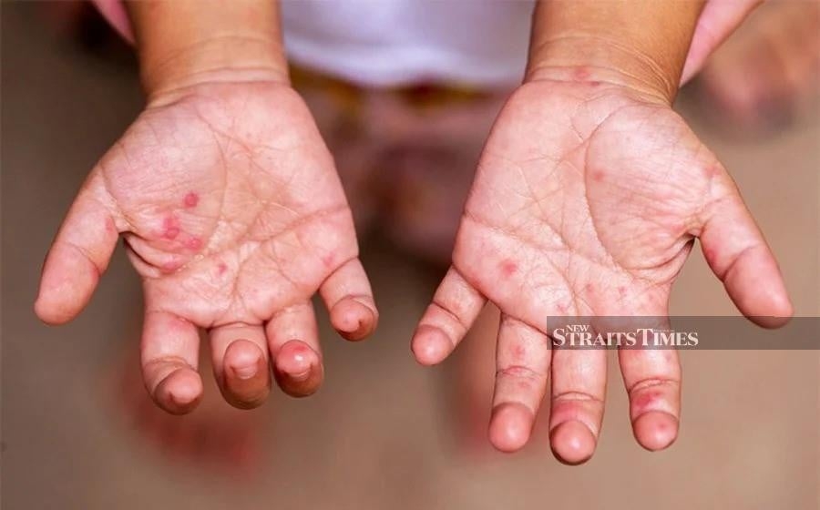 Childcare centre, kindergarten operators urged to conduct screenings to curb HFMD