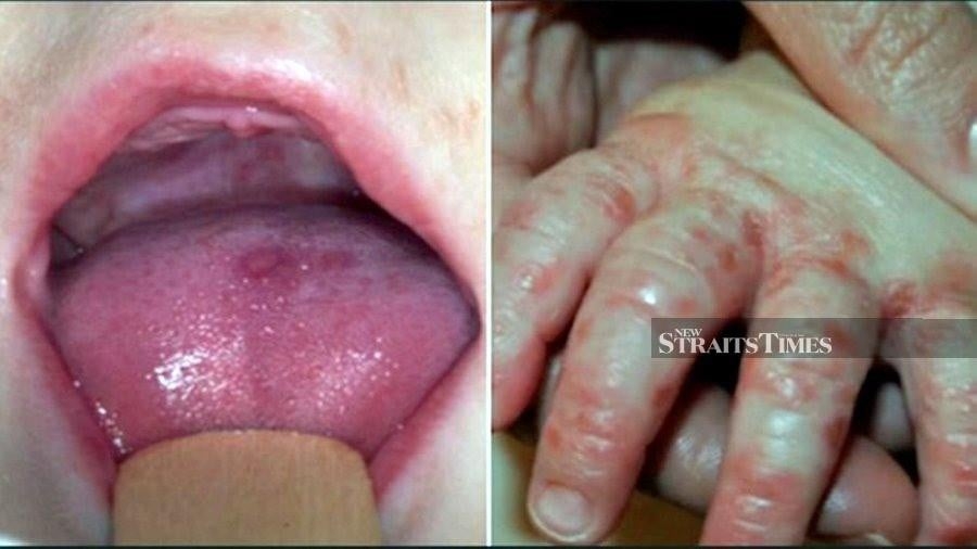 Week 17 shows 99,601 HFMD cases reported nationwide