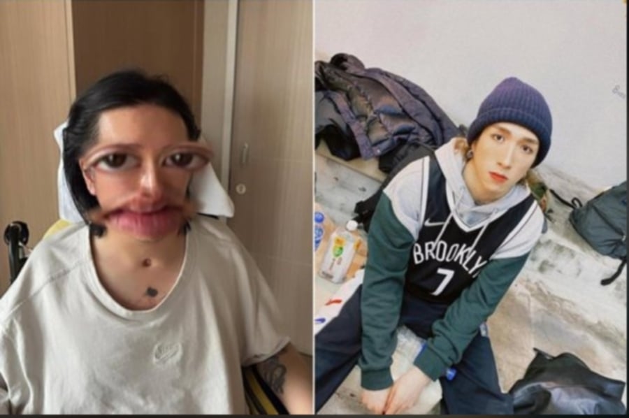#SHOWBIZ: Dancer Lee Kai Yin shares first photo of face since 2022 'Mirror accident'