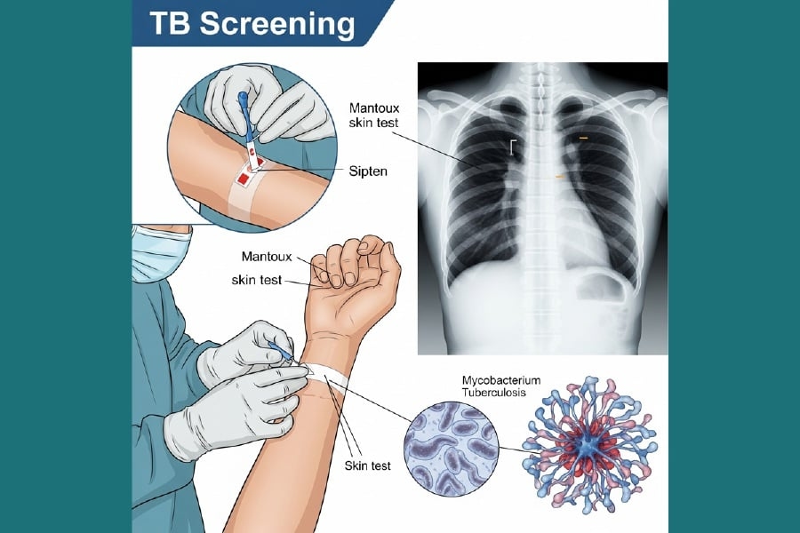 Japan begins mandatory TB screening for visitors staying over 3-months