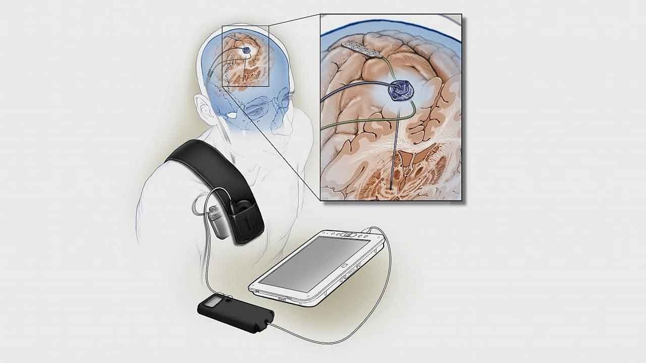 Brain implants that are helping people with Parkinson's