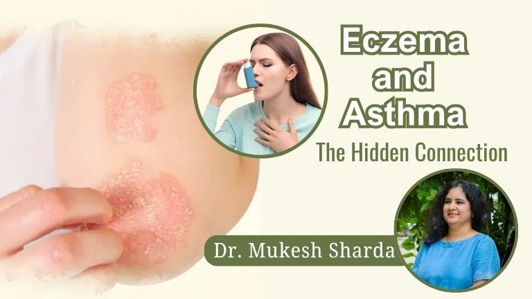 Eczema and Asthma: The Hidden Connection
