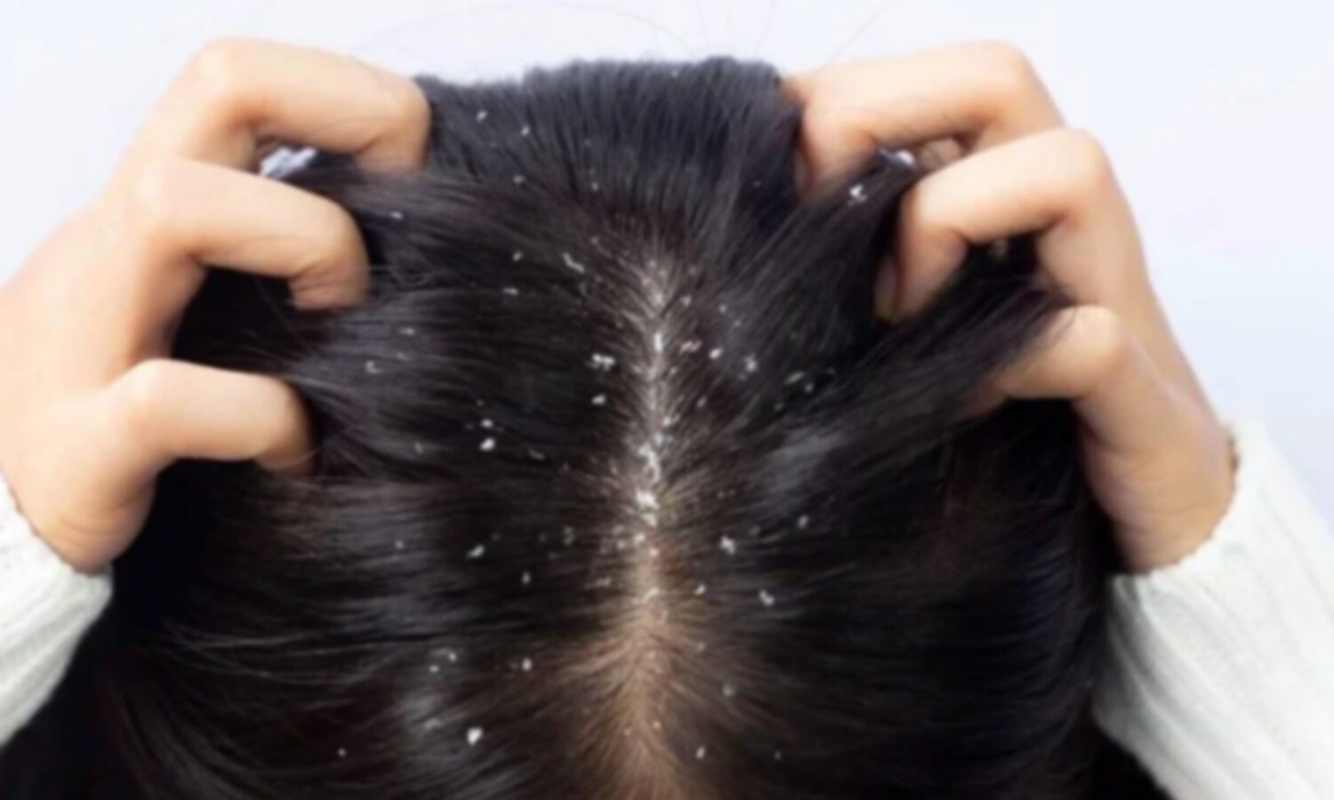 Natural DIY Remedies to Banish Dandruff This Monsoon