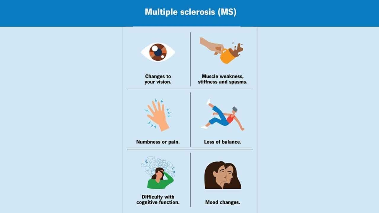 Multiple sclerosis may emerge a decade before neurological symptoms begin to appear