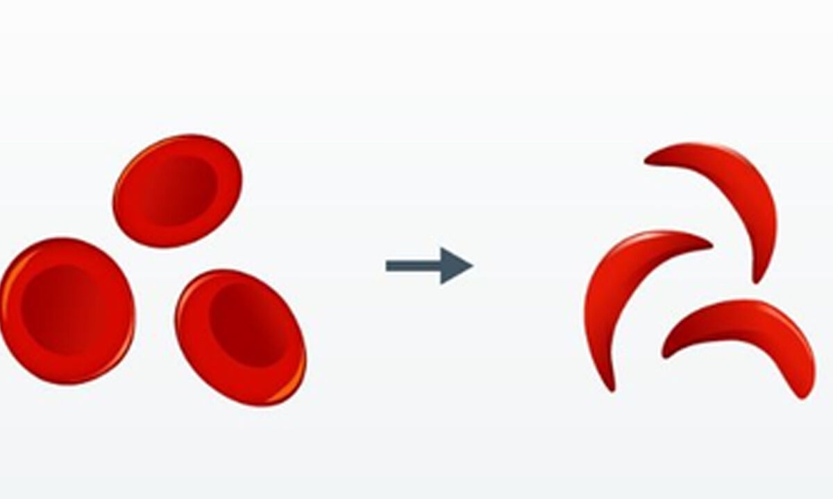 Sickle Cell elimination mission tackling genetic disorder to ensure equity, dignity: PMO