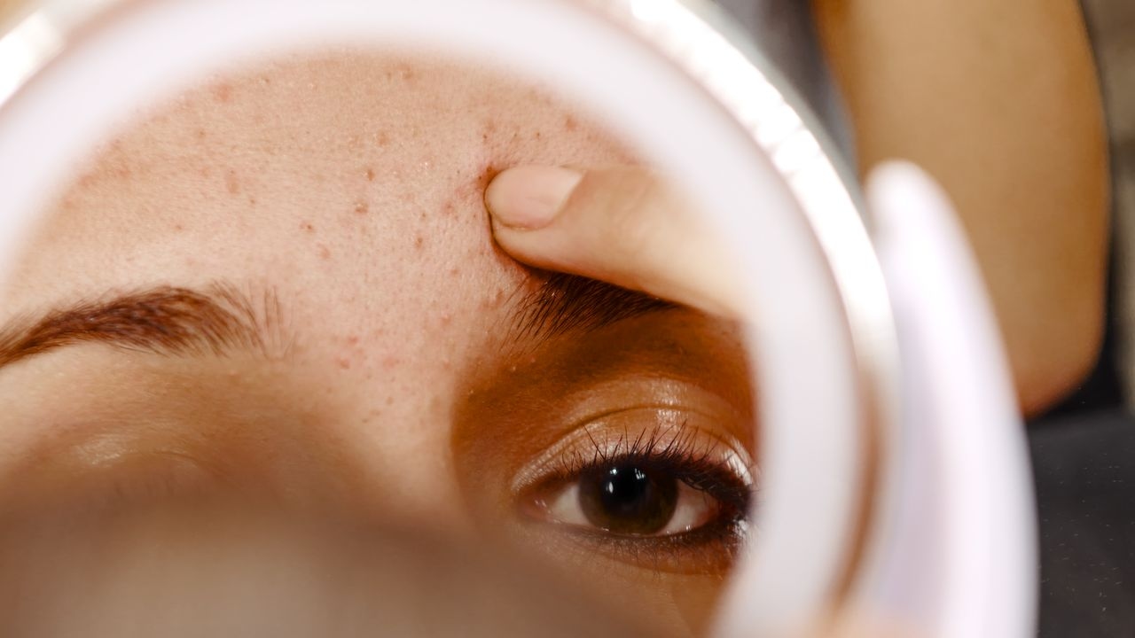 It's Not a Whitehead, It's Milia—Here's How to Treat It