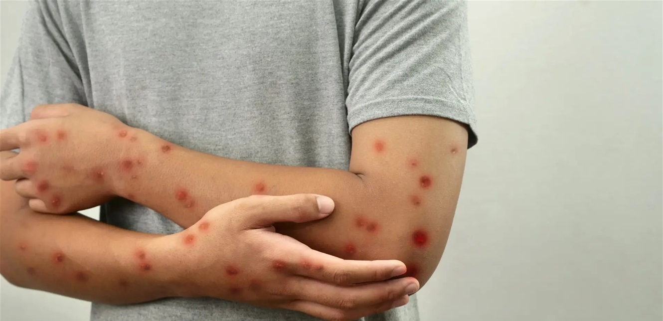 حصبة تكتسح أميركا: تسجيل نحو 900 حالة والإصابات تتزايد