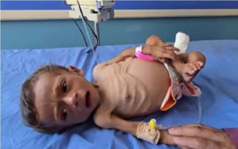 مرض نادر يتفشّى في غزة بسبب مخلفات العدوان الإسرائيلي…