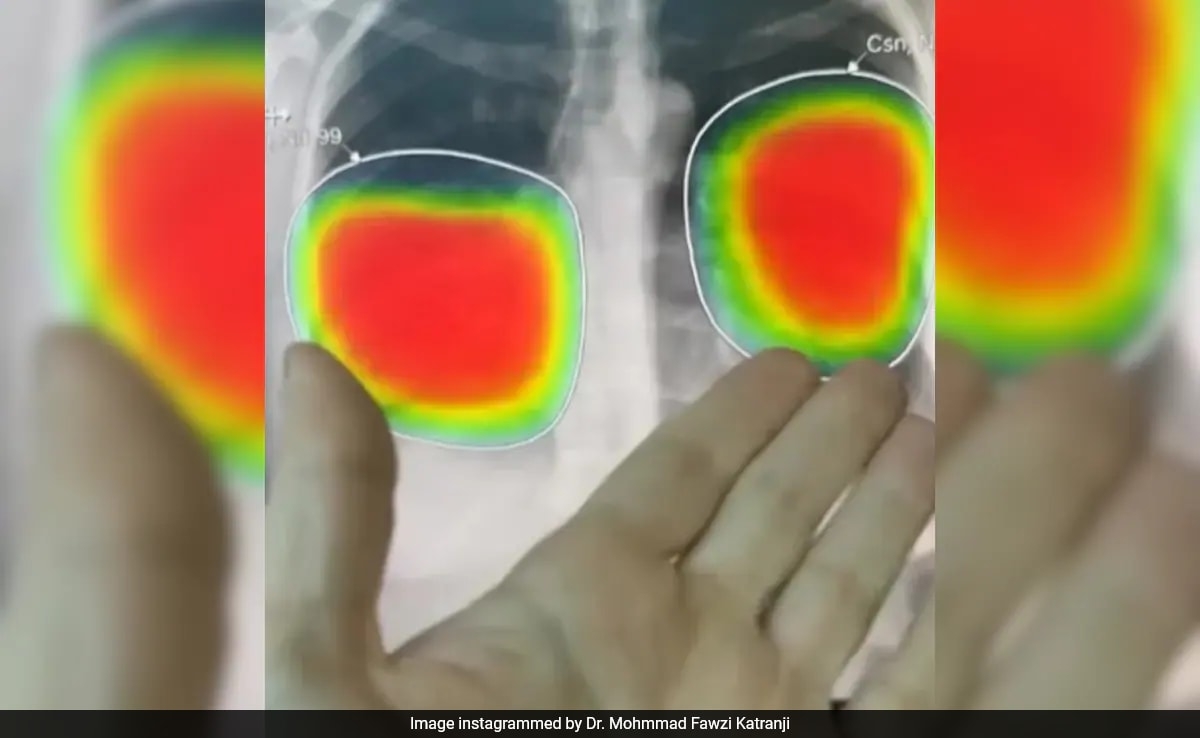 Dubai Doctor Fears Losing His Job As AI Accurately Analyses X-Ray: "Going To Apply To McDonald's"