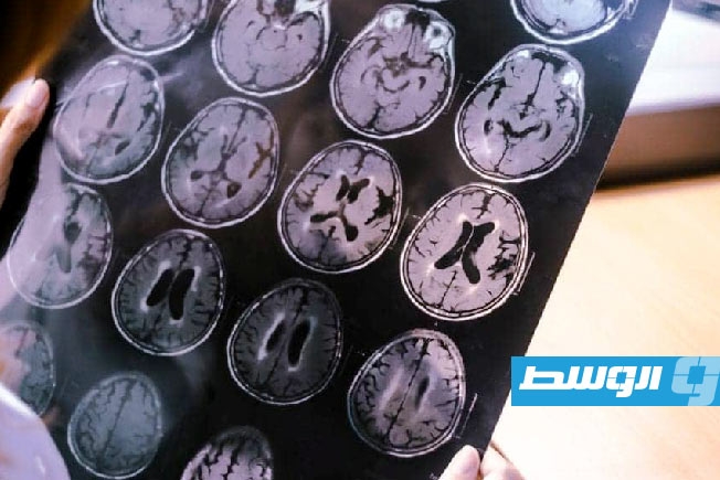 دراسة ضخمة تحدد 15 عاملا للإصابة بالخرف المبكر لدى الشباب