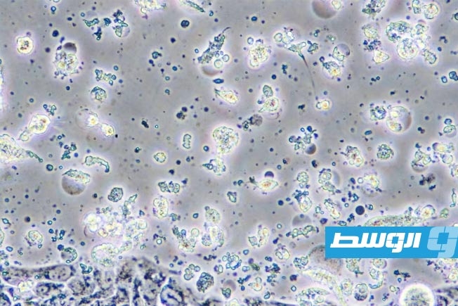 دراسة تكشف السبب وراء انتشار سرطان الأمعاء بين الشباب