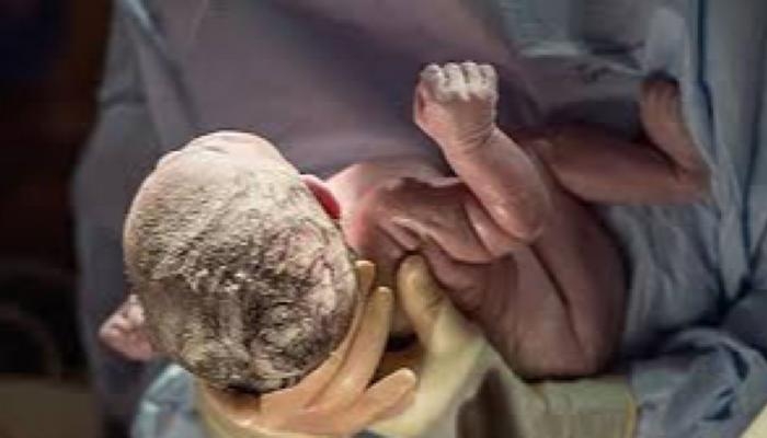 جراحون أفغان ينجحون في استخراج جنين من بطن رضيع